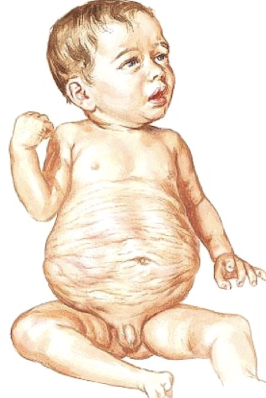 <ul><li><p>aka <span style="color: red;">Eagle-Barrett Syndrome</span></p></li><li><p>rare congenital disorder characterized by:</p><ul><li><p>dilation of collecting system, cryptorchidism, and <span style="color: red;">agenesis/hypoplasia of abdominal wall muscles</span></p></li></ul></li><li><p>seen mostly in male fetuses</p></li><li><p>associated with megacystitis and posterior urethral valves</p></li><li><p>prognosis depends on severity and renal function </p></li></ul><p></p>