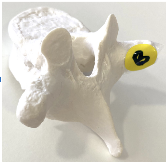 <p>What vertebrae is this? What bony feature is ‘B’</p>