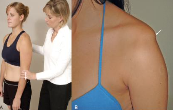 <ul><li><p><span>PURPOSE: To test for inferior shoulder instability</span></p></li><li><p><span>DESCRIPTION: The patient stands with the arm by the side and shoulder muscles relaxed. The examiner grasps the patient’s forearm below the elbow and pulls the arm distally</span></p></li><li><p><span>RESULT: The presence of a sulcus sign may indicate inferior instability or glenohumeral laxity but should only be considered positive for instability if the patient is symptomatic</span></p></li></ul><p></p>