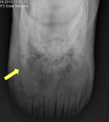 <p>What is the treatment for a type VI P3 fracture?</p>