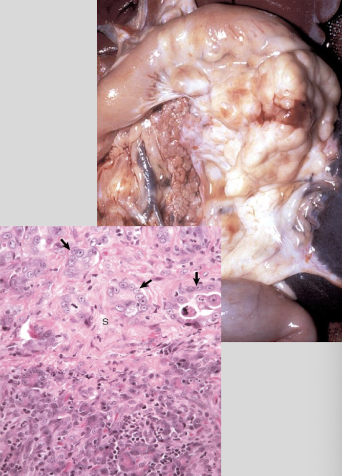 <p>usually presents as single mass, gray to yellow w/ frequent hemorrhage &amp; necrosis, firm to schirrous consistency, adhesions to adjacent organs common</p>