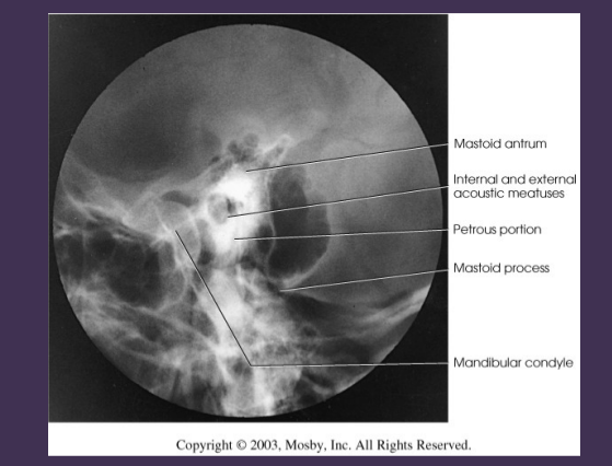 <p>aff side</p><p></p><p>condyle lying in mandibular fossa in (CLOSED MOUTH)</p><p>condyle lying <strong>inferior</strong> to articular tubercle in (OPEN MOUTH)</p>