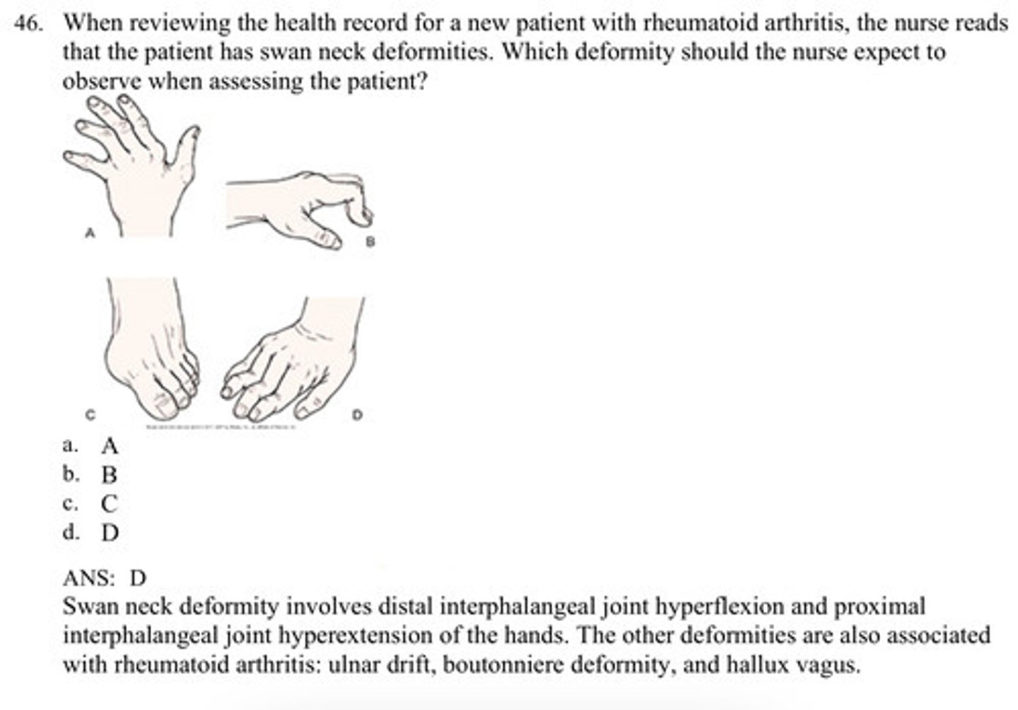 <p>ANS: D Swan neck deformity involves distal interphalangeal joint hyperflexion and proximal interphalangeal joint hyperextension of the hands. The other deformities are also associated with rheumatoid arthritis: ulnar drift, boutonniere deformity, and hallux vagus</p>