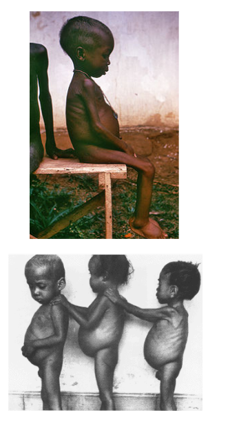 <p>Protein deficiency</p><p>High CHO foods → Cassava</p><p>Weaned from breast milk to cassava</p><p>Osmotic imbalance in gut = swelling</p><p>Liver enlarged due to inability to export fat from liver (no VLDL made)</p>