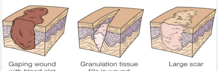 <p>- wound margins not well approximated<br>- larger wound area requires formation of granulation tissue to fill gaps<br>- longer period of time needed to heal<br>(think open wound, edges cannot be pulled together, granulation tissue has to be grown to fill in missing tissue)</p>