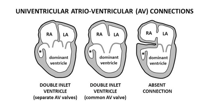 <p>When describing the type of AV connection…we should determine whether it’s biventricular or univentricular</p>