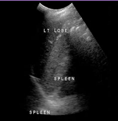 <p>When left lobe of liver extends into LUQ </p>