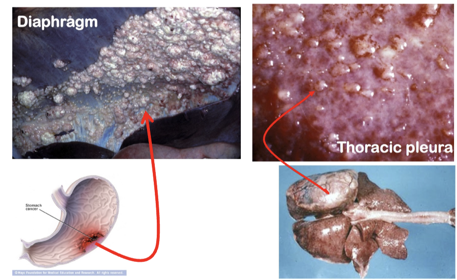 <p><strong>Direct spread/implantation of carcinoma throughout a body cavity</strong></p><ul><li><p>It <strong>does not require a blood vessel</strong> for spread</p></li></ul><p></p>
