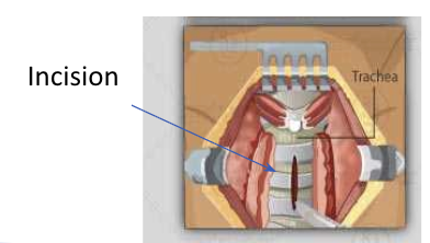 <p><span style="background-color: transparent;">Tracheotomy</span></p>