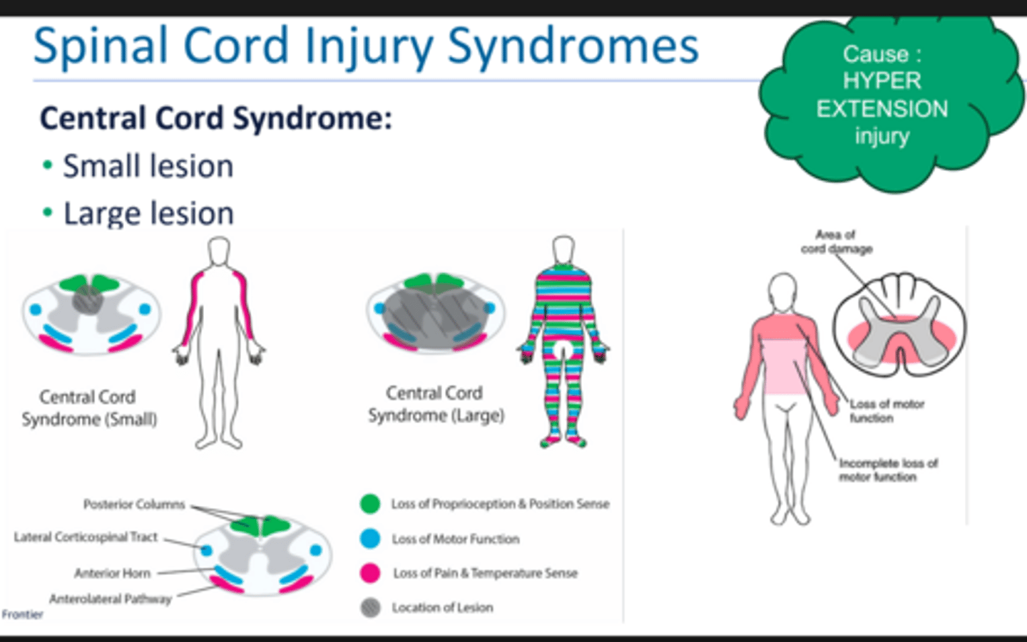 <p>aka walking SCI</p><p>hyperextension injury</p><p>if small lesion: bilateral pain and temp</p><p>if large lesion: </p><p>-loss of motor and sensory function </p><p>-affects motor > sensory </p><p>-affects UE > LE and proximal > distal </p><p>SAFETY RISKS BUT USUALLY CAN AMBULATE </p><p>affected tracts: spinothalamic, corticospinal, dorsal column </p>