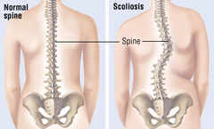 <p>An abnormal lateral (side-to-side) curvature of the spine, often with rotation of the vertebrae, that can occur in the thoracic and/or lumbar region. </p><p>Occurs in the coronal plane and deviates right or left</p>