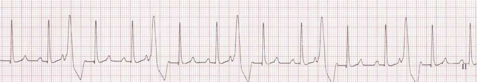 <p>The ___ arrhythmia is characterized by wide and bizarre QRS complexes without a P wave. There are different types of this arrhythmia which include unifocal, multifocal, and runs. Please name the arrhythmia. </p>