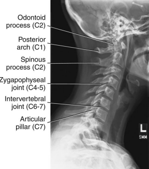<ul><li><p>Cervical vertebral bodies, intervertebral joint spaces, articular pillars, spinous processes, and zygapophyseal joints demoed</p></li><li><p>C1 through C7-T1 intervertebral joint spaces are clearly seen</p></li><li><p>R and L articular pillars and zygapophyseal joints should be superimposed for each vertebra</p></li><li><p>Bodies free of superimposition of the articular pillars</p></li><li><p>Spinous process seen in profile</p></li></ul><p></p>