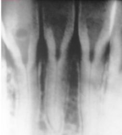 <p>Radiographic features: Deciduous - roots are extremely short, pulps are almost completely obliterated.</p><p> Permanent dentition - abnormally large pulp chambers in the coronal portion of the teeth.</p>