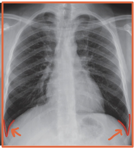 <p>The sharp recess where the diaphragm meets the chest wall</p>