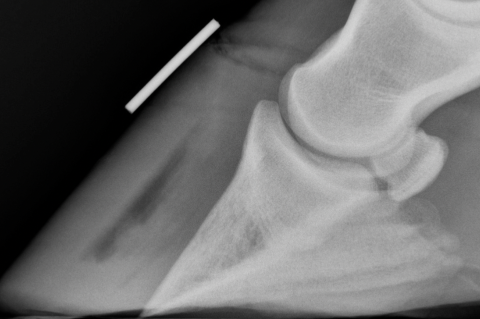 <p>Same lateral equine distal foot radiograph. Close-up emphasis on the dorsal hoof wall region where the lamellar interface is visible. A broad, linear gas opacity is present at the dorsal lamellar zone between the hoof wall and coffin bone. Adjacent hoof wall soft tissue appears intermediate gray. Coffin bone appears bright cortical white adjacent to the gas crescent.</p><p><br></p><p></p><p><strong>Which explanation correctly accounts for why the lamellar gas is visible on this radiograph AND how its opacity category confirms it is gas rather than fluid?</strong></p><p>a. The gas pocket is visible because gas has negligible X-ray attenuation relative to the adjacent cortical bone and soft tissue — this large attenuation difference creates high local contrast, making the gas crescent clearly visible. Its very dark appearance (darker than all adjacent soft tissue) confirms it is gas rather than fluid, since fluid would attenuate similarly to the surrounding hoof wall soft tissue.</p><p>b. The gas pocket is visible because it is located at the lamellar interface, a clinically important region — its visibility reflects the clinical significance of the finding rather than a physical property of gas. Fluid would appear identically because both gas and fluid are non-mineralized.</p><p>c. The gas pocket is visible because it is denser than the surrounding soft tissue, causing it to attenuate more X-rays and appear distinctly bright against the adjacent structures. Its bright appearance distinguishes it from fluid, which would appear darker.</p><p>d. The gas pocket is visible because it has accumulated sufficient volume to be detectable by the radiographic detector — small volumes of gas would be invisible regardless of their attenuation properties. Fluid would appear similarly dark if the same volume were present.</p>