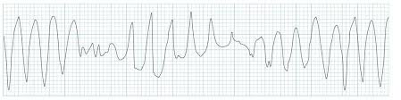 <p></p><ul><li><p>Wide QRS complex (>0.12 sec), regular rhythm</p></li><li><p>May have pulse or pulseless</p></li><li><p>Monomorphic or polymorphic (Torsades)</p></li></ul><p></p>