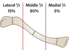 <p>most commonly fractured bone in upper limbs </p><p>at the junction of middle and lateral thirds</p>