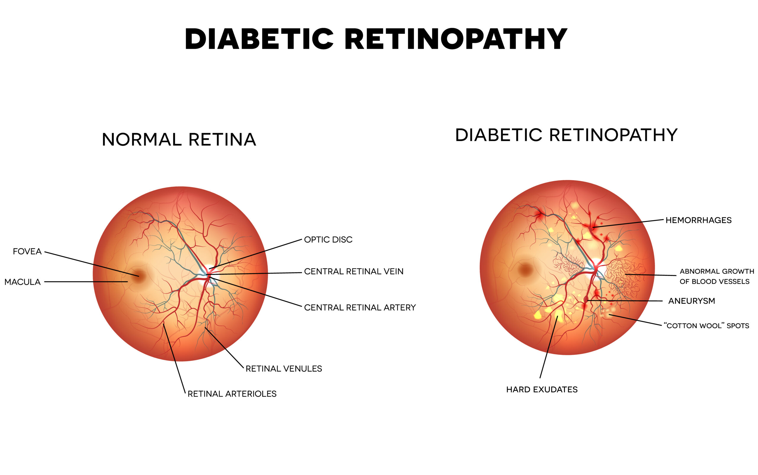 <p>RF: high blood sugar<br>DM length</p><p>E: leading cause of blindness in US<br>proliferative vs non-proliferative<br>-mild<br>-moderate<br>-severe</p><p>CM: vision fluctuations<br>floaters<br>vision spots<br>shadow in vision<br>distorted/blurry vision<br>slow healing eye lesions<br>diplopia<br>macular edema</p><p>TX: depends on severity</p>
