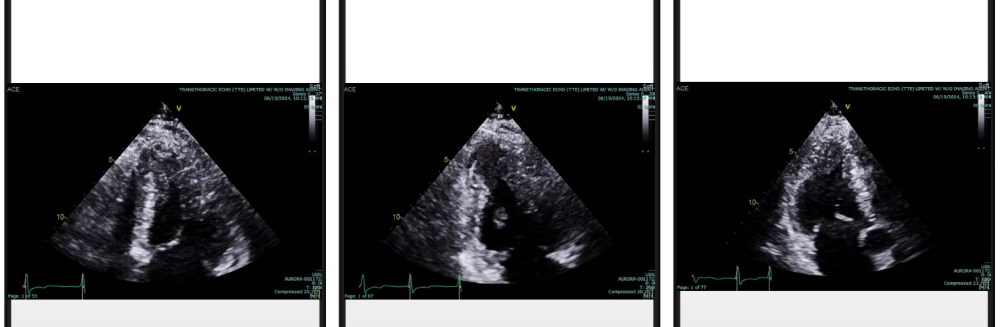 <p>What HCM variant is introduced here?</p>