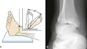 <p>Posterior aspect of the medial malleolus</p><p>Distal tibia</p>