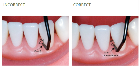 <p>Correct vs incorrect angulation</p>