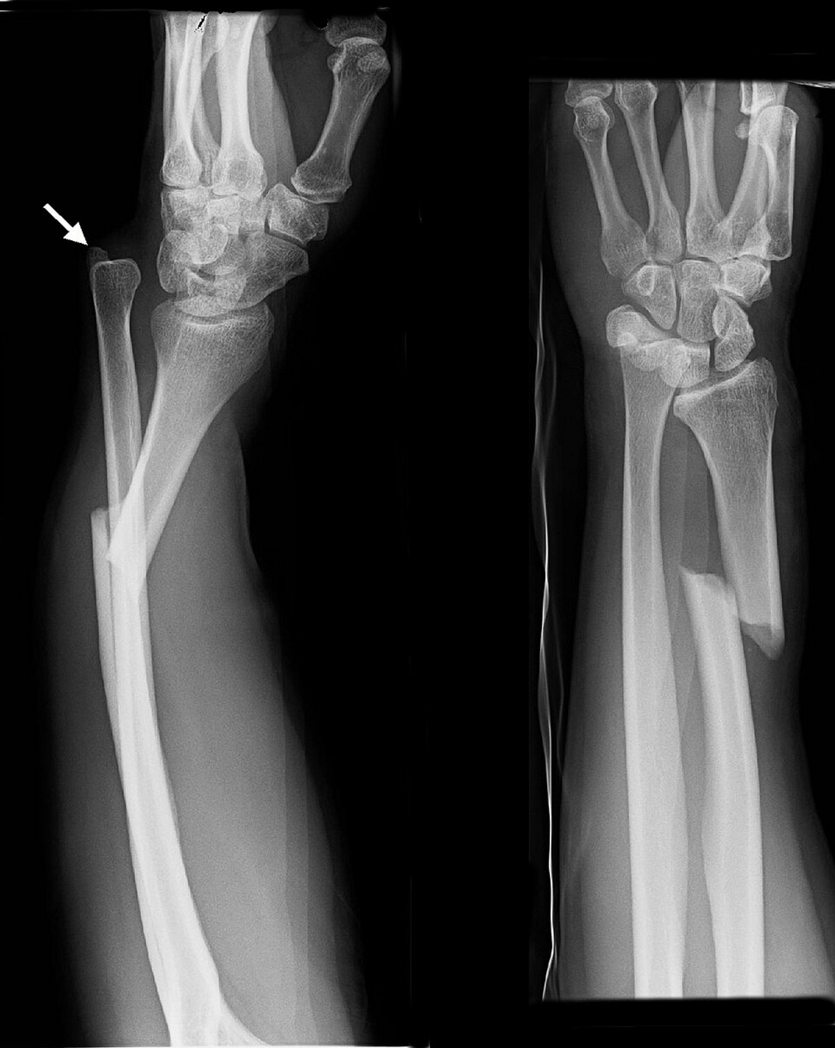 <p>Fracture of distal radius + disruption of distal radio-ulnar joint (DRUJ)</p>