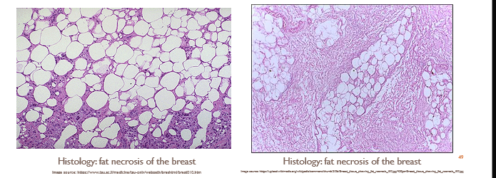 <ul><li><p>Change in adipose tissue due to trauma or the release of enzyme from adjacent organs</p></li></ul><p></p><ul><li><p>Large, lipid filled vacuoles</p></li></ul><p></p>