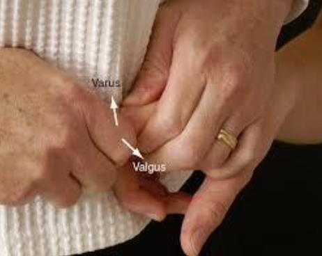 <ul><li><p><span>PURPOSE- Identify ligament instability, medial or lateral</span></p></li><li><p><span>DESCRIPTION- Fingers are stabilized and supported. Varus or valgus stress applied to the joint (proximal or distal interphalangeal) to test the integrity of the collateral ligaments</span></p></li><li><p><span>RESULT- The results are compared for laxity with those of the uninvolved hand, which is tested first.</span></p></li></ul><p></p>
