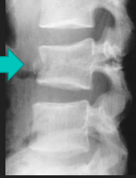 <p>Chance Fractures</p>