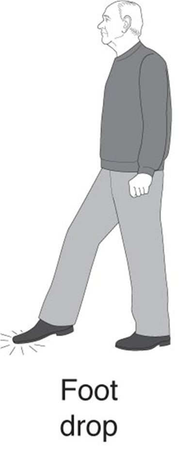 <p>foot drop </p>