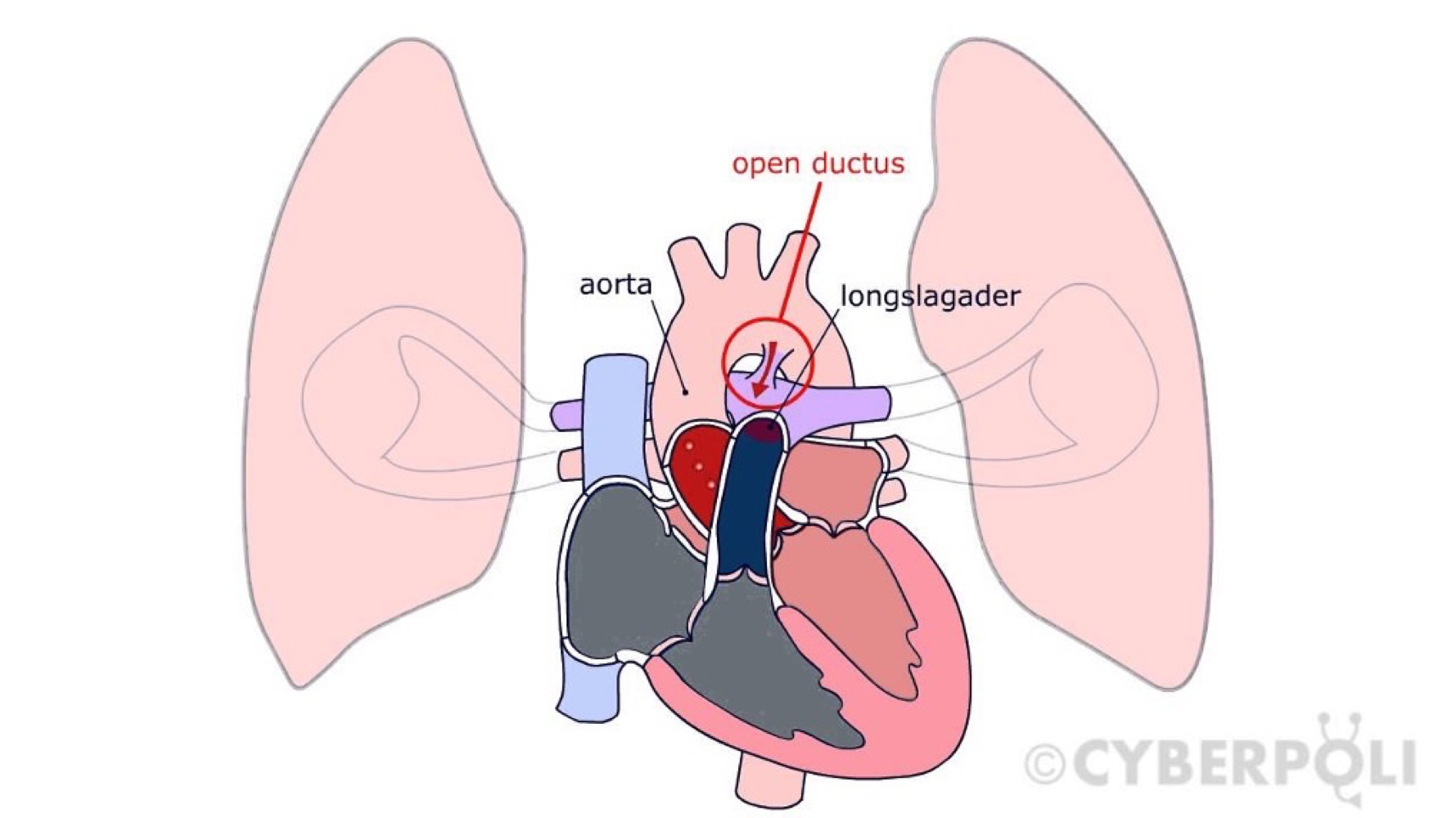 <ul><li><p>Closure in newborn </p></li><li><p>If it’s open mixed level of oxygenated blood enters the lungs </p></li><li><p>Can close within 6 months after birth naturally if not then surgery is needed otherwise oxygen problems. </p></li></ul><p></p>