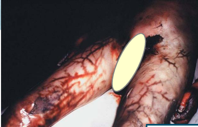 <p>Questions</p><ol><li><p>What postmortem change is characterized by a distinctive, web-like pattern on the skin?</p></li><li><p>What is the underlying cause of the change of the skin during putrefaction?</p></li></ol><div data-type="horizontalRule"><hr></div><p></p>