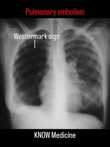 <p>Dark lung region due to decreased blood (oligemia) flow from a pulmonary embolus.</p>
