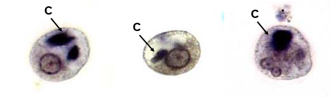 <p>Symptoms and Keywords for Entamoeba histolytica</p>