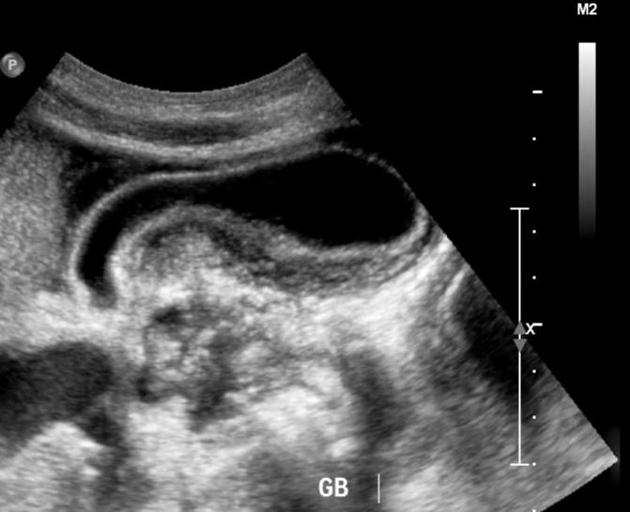 <p>Inflammed gallbladder with no sure stones. Imaging suggests acalculous cholecystitis.</p>