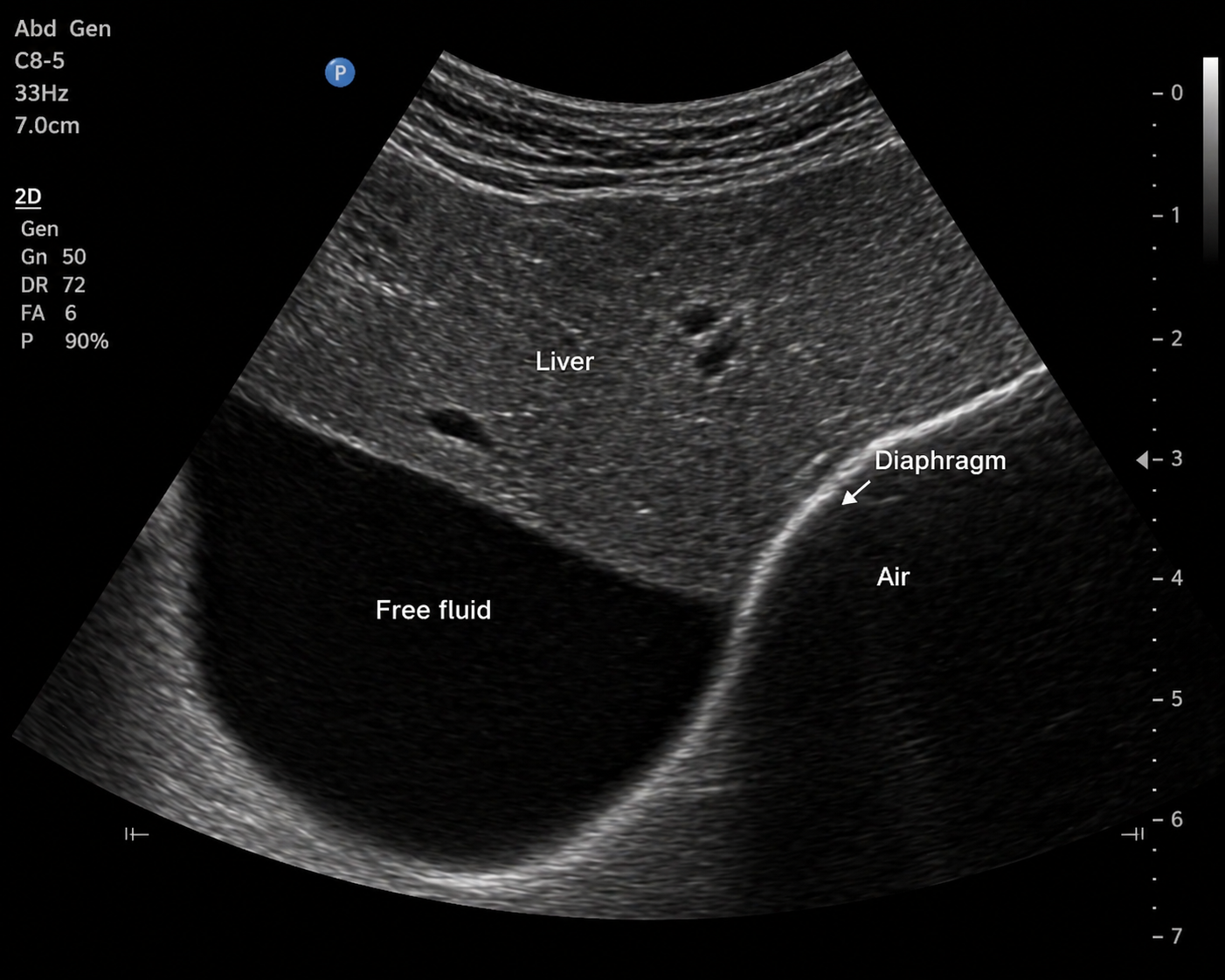 <p>Barnaby presents with progressive abdominal distension over 5 days.</p><p>Background: ultrasound produces images by emitting sound waves from the transducer and recording the echoes that return. Structures that reflect many echoes appear bright (hyperechoic); structures that reflect few echoes appear dark (hypoechoic); structures that transmit sound with almost no reflection appear uniformly dark (anechoic).</p><p>An abdominal ultrasound is performed. The image shows three distinct regions:</p><p>• Region 1: a uniformly dark region between the liver and diaphragm with no internal architecture</p><p>• Region 2: the hepatic parenchyma showing a granular speckled gray texture</p><p>• Region 3: a bright linear boundary at the lung diaphragm interface</p><p>The clinician asks a student to correctly identify each region using standard echogenicity terminology.</p><p>Canine abdominal ultrasound:</p><p></p><p><strong>Which statement correctly identifies all three regions using standard echogenicity terminology and explains the echo-return mechanism responsible for each?</strong></p><p><span>a. Region 1 is hyperechoic (many echoes returning from dense fluid); Region 2 is anechoic (liver parenchyma produces no echoes); Region 3 is hypoechoic (the diaphragm partially reflects sound).</span></p><p><span>b. Region 1 is anechoic (free fluid transmits sound with minimal reflection, producing few returning echoes); Region 2 is hypoechoic to intermediate (liver parenchyma produces moderate echoes from tissue interfaces); Region 3 is hyperechoic (the diaphragm-lung interface causes near-total reflection of the sound beam).</span></p><p><span>c. Region 1 is hypoechoic (fluid partially absorbs sound waves, reducing but not eliminating echo return); Region 2 is hyperechoic (the dense liver tissue strongly reflects all incoming sound); Region 3 is anechoic (the diaphragm transmits sound into the air-filled lung without reflection).</span></p><p><span>d. Region 1 is anechoic (correct); Region 2 is hyperechoic (liver parenchyma is the brightest structure on abdominal ultrasound because it contains the most tissue); Region 3 is hypoechoic (diaphragm tissue is less reflective than liver).</span></p><p></p>