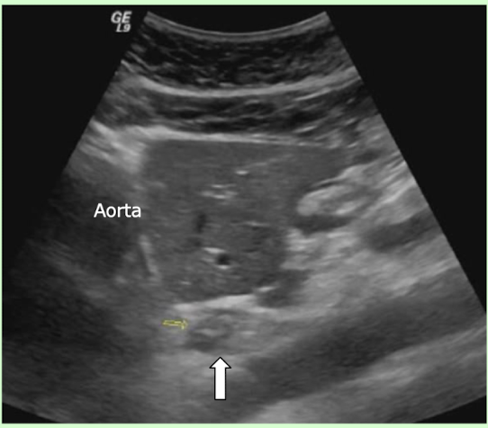 <p>What is the arrow pointing to posterior to the left liver and anterior to the abdominal aorta?</p>
