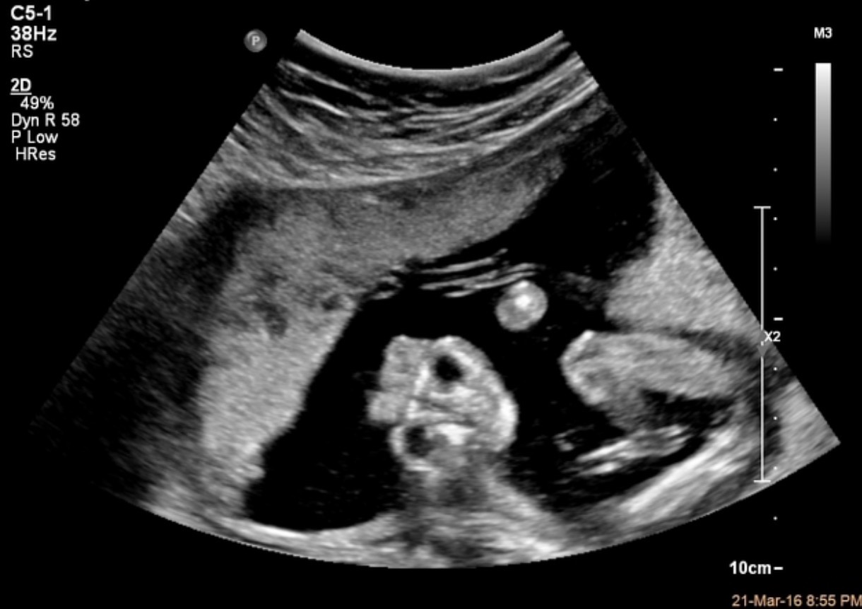 <p>What pathology is seen in this image?</p>