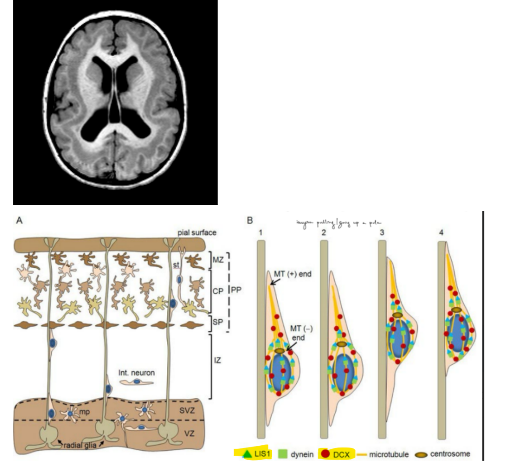 <p>DCX mutation results in <strong><u>subcortical band heterotopia</u></strong>, that resembles a <u>“double cortex”</u></p><ul><li><p>^ <u>heterotopia </u>— “out of place”</p></li><li><p>more common in <u>females </u>b/c male fetuses die before birth due to having only 1 X chromosome (males have a more severe form of lissencephaly)</p></li></ul><ul><li><p>DCX is a <u>microtubule</u>-associated protein</p></li></ul><p>…</p><p>both <strong>LIS1 </strong>and <strong>DCX </strong>are involved in regulating MTs during cell migration, which includes <strong><u>nucleokinesis</u> </strong>(<u>the translocation of the nucleus as the migrating neuron crawls up the MT</u>)</p><ul><li><p>SO mutations of either of the 2 MT-associated proteins lead to <u>migration defects</u> and as a result <u>improper layering</u></p></li></ul><p><span style="color: purple;"><u>(^ improper layering AKA misorganization of the 6 layers of the mammalian cerebral cortex)</u></span></p><p>____________</p><p>growth cones and tips of migrating neuron both require MTs coordination with F-actin, but they differ in <u>what is being moved</u>, where:</p><ul><li><p>growth cones move the <u>axon</u></p></li><li><p>migrating neurons move the <u>nucleus</u></p></li></ul><p></p>