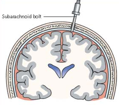 <p>placed just through skull to monitor ICP but does not allow for CSF drainage</p>