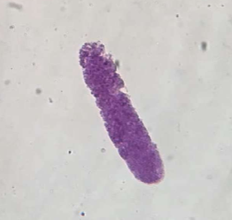 <ul><li><p>hyaline cast with granules </p></li><li><p>acute nephritis </p></li></ul><p></p>