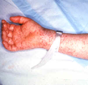 <p>Rocky Mountain Spotted Fever (S/S & Treatment)</p>