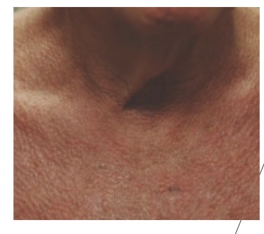 <p>Red patches in sun-damaged areas w/ fine telangiectasias and area of BOTH hyperpig and hypopig</p>