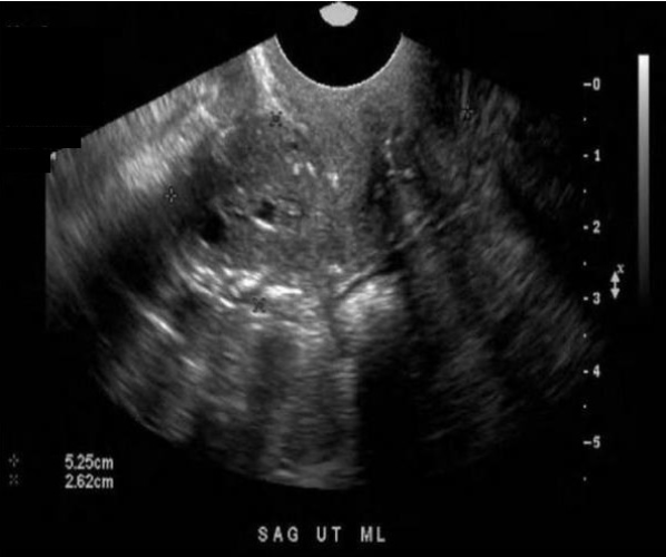 <p>All of the following are associated risk factors for the endometrial findings displayed, except:</p><p>A. Estrogen replacement therapy</p><p>B. Tamoxifen therapy</p><p>C. Multiparous</p><p>D. Polycystic Ovarian Disease</p>