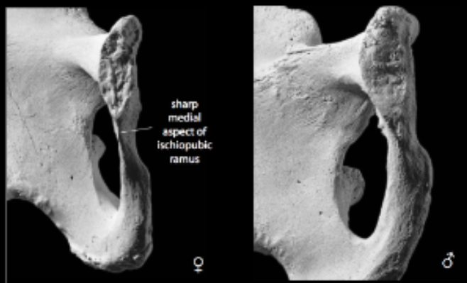 <p>Ischiopubic Ramus - Pelvis </p>