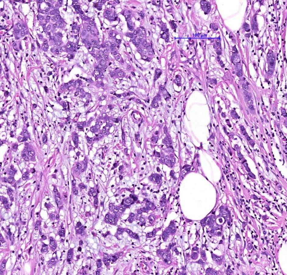 <p>Breash carcinoma DCIS</p><p>intermingled with infiltrative carcinom a NST, poorly differentiated</p><p>•basement membrane of ducts: continuous / preserved</p><p>•central necrosis in dilated ducts</p><p>nests</p><p>ribbons of malignant</p><p>epithelial cells within a focally</p><p>dense fibrous stroma adipose</p><p>tissue infiltration</p>