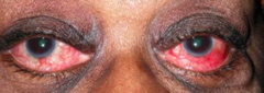 <p>•Corneal changes</p><p>•Glaucoma</p><p>•Cataracts</p><p>•Posterior segment complications</p><p>SEVERE PAIN</p>
