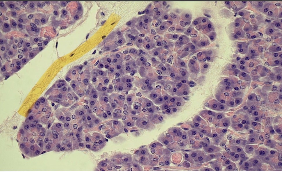 <p>Category of stroma that separates lobules</p>