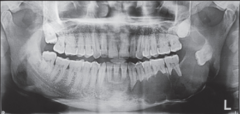 <p>describe the effect of the lesion:</p>